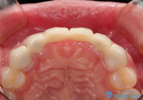 前歯 ブリッジ周囲の腫れた歯ぐきを改善の治療前