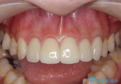 不適合なクラウンのやりかえの治療後