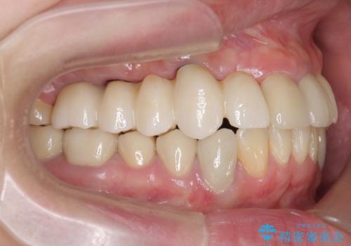 虫歯による多数歯欠損　インプラント咬合機能回復の治療後