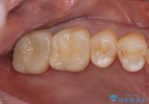 目立つ銀歯を白くしたいの治療後