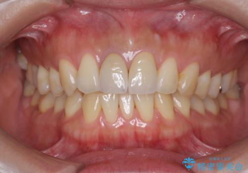 前歯の変色　根管治療と高品質セラミック歯科治療の治療後