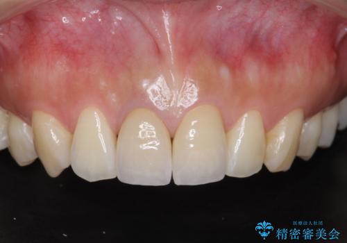 前歯の変色　根管治療と高品質セラミック歯科治療の症例 治療後