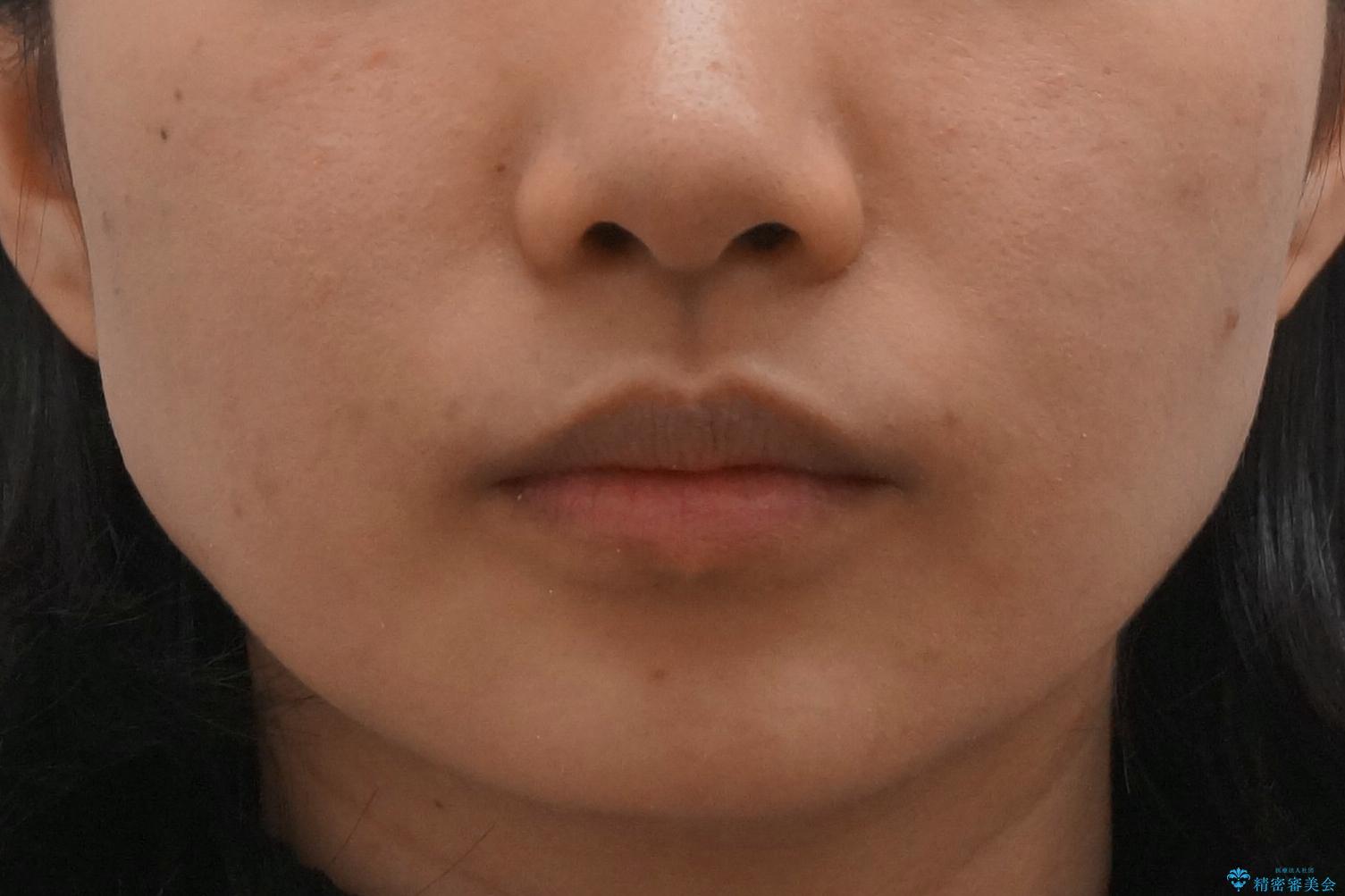 Eラインを整える治療 前歯を引っ込めますの治療後(顔貌)