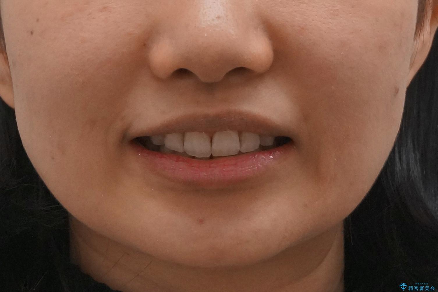 Eラインを整える治療　前歯を引っ込めますの治療後（顔貌）