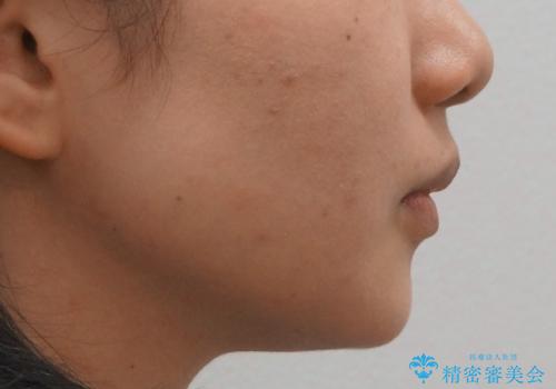Eラインを整える治療 前歯を引っ込めますの治療後