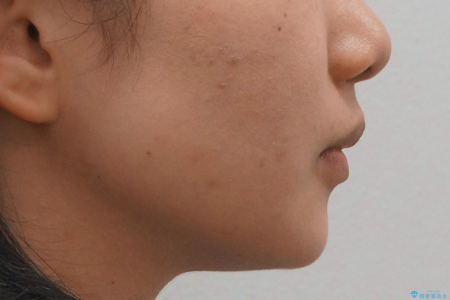 Eラインを整える治療 前歯を引っ込めますの治療後(顔貌)