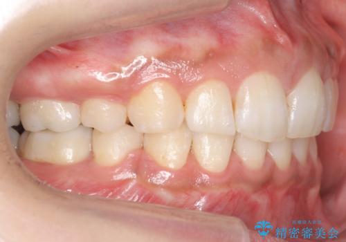 Eラインを整える治療 前歯を引っ込めますの治療後