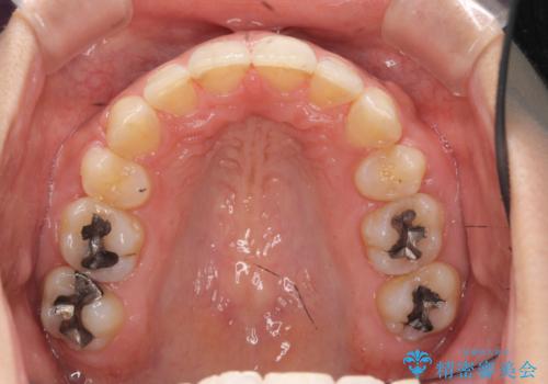 Eラインを整える治療 前歯を引っ込めますの治療後