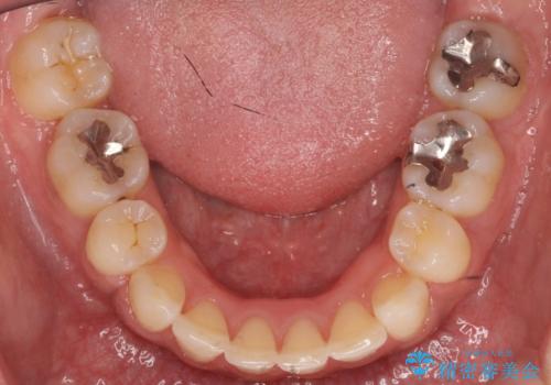 Eラインを整える治療 前歯を引っ込めますの治療後