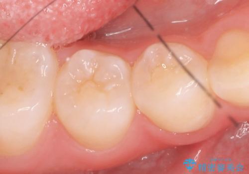 セラミックインレー　しみる歯の審美的治療の症例 治療前