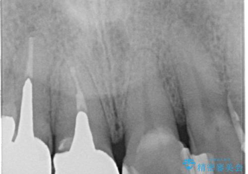 不自然な前歯のかぶせ物をオールセラミックへの治療前