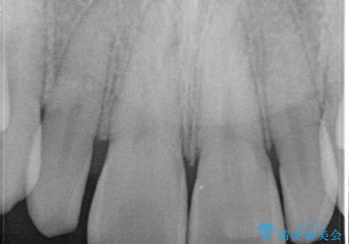 矮小歯(通常より小さな歯)をオールセラミックを装着して自然な歯への治療前