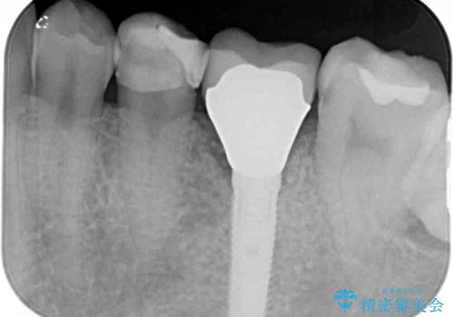 セラミッククラウンによる奥歯のむし歯治療の治療前