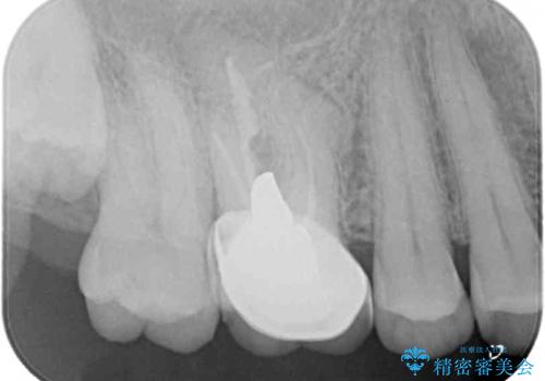 歯周外科処置を併用した奥歯の補綴治療の治療前