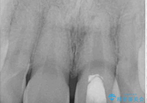 ぶつけた前歯 変色歯をオールセラミッククラウンにの治療前