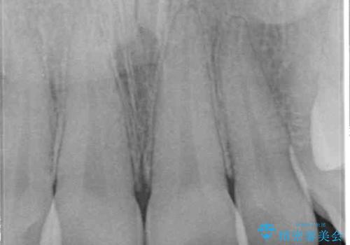 捻れた出っ歯の前歯 オールセラミッククラウンによる審美治療の治療前
