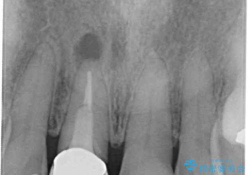 金属を全てセラミックに メタルフリー治療の治療前