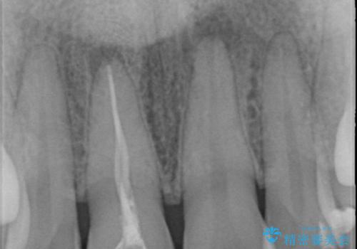 前歯の変色　根管治療と高品質セラミック歯科治療の治療前