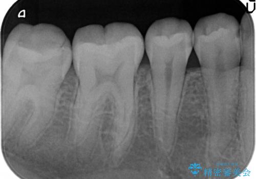 セラミックインレー しみる歯の審美的治療の治療前