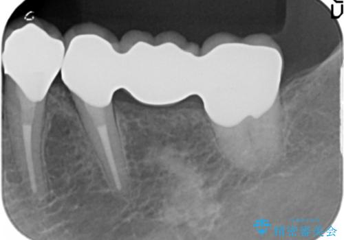 [奥歯のセラミック治療] 銀歯のブリッジを白くの治療後