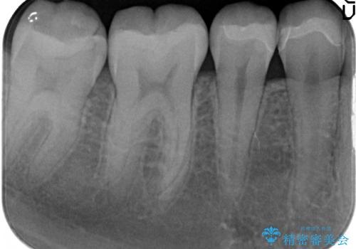 セラミックインレー しみる歯の審美的治療の治療後