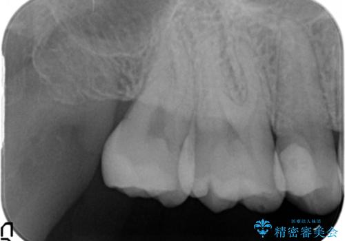 奥歯の虫歯 セラミックインレーにの治療後