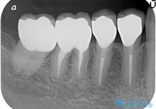 大臼歯 再根管治療の治療後