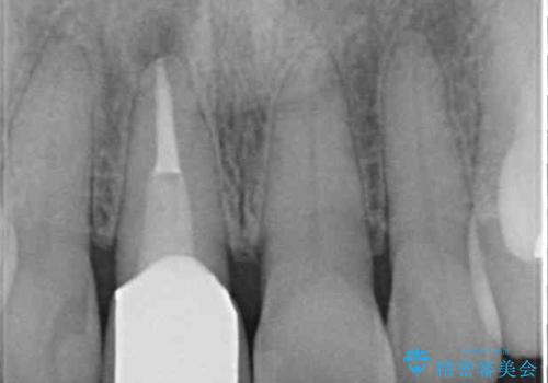 金属を全てセラミックに メタルフリー治療の治療後