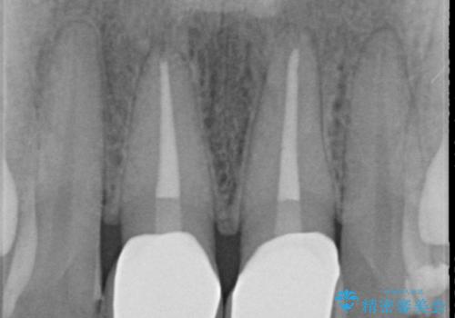 前歯の変色 根管治療と高品質セラミック歯科治療の治療後