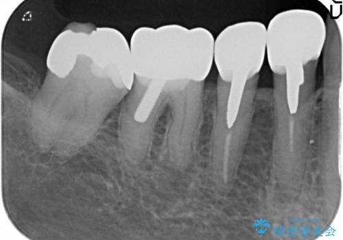 大臼歯 再根管治療の治療前