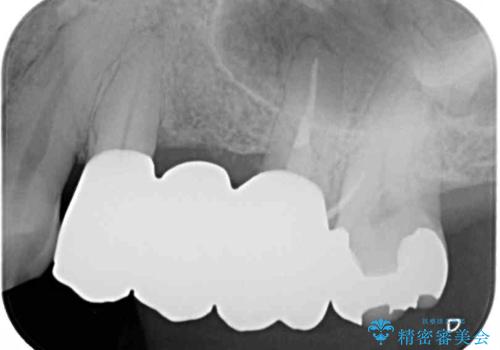 ものが挟まる 奥歯のセラミックブリッジ再製作の治療後