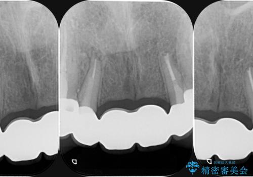前歯 ブリッジ周囲の腫れた歯ぐきを改善の治療後