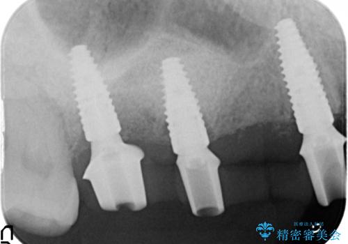 虫歯による多数歯欠損　インプラント咬合機能回復の治療中
