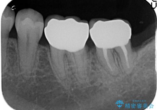 オールセラミッククラウン 歯茎より深い虫歯の治療 神経が死んでる歯の治療の治療後