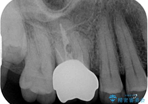 歯周外科処置を併用した奥歯の補綴治療の治療後