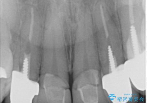 不適合なクラウンのやりかえの治療前