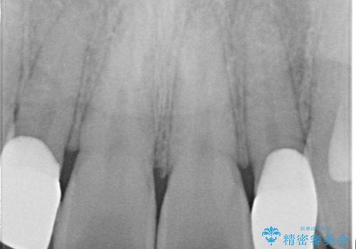 矮小歯(通常より小さな歯)をオールセラミックを装着して自然な歯への治療後