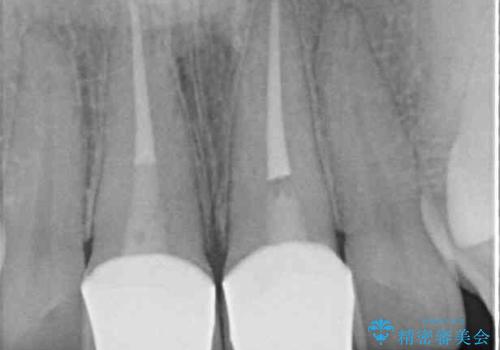 捻れた出っ歯の前歯 オールセラミッククラウンによる審美治療の治療後