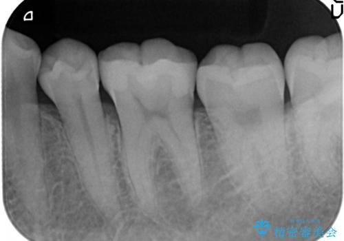 マイクロスコープ下で行う精密虫歯治療の治療後
