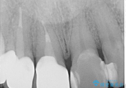 不自然な前歯のかぶせ物をオールセラミックへの治療後