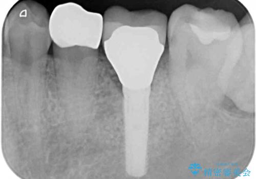 セラミッククラウンによる奥歯のむし歯治療の治療後