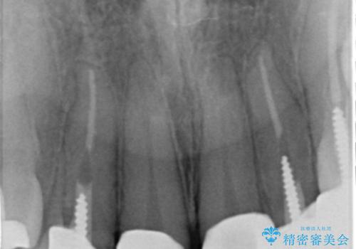 不適合なクラウンのやりかえの治療後