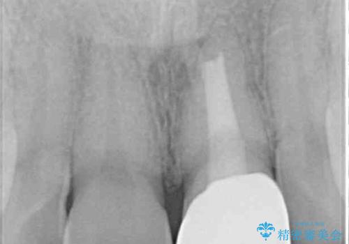 ぶつけた前歯 変色歯をオールセラミッククラウンにの治療後