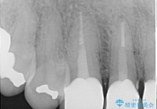 不自然な前歯のかぶせ物をオールセラミックへの治療後