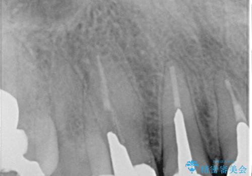 不自然な前歯のかぶせ物をオールセラミックへの治療前