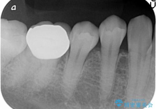 目立つ銀歯を白くしたいの治療後