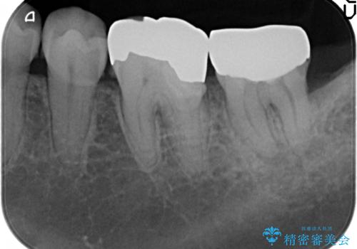 オールセラミッククラウン　歯茎より深い虫歯の治療　神経が死んでる歯の治療の治療前
