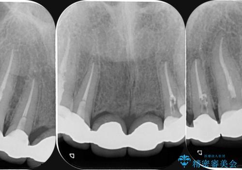 前歯　ブリッジ周囲の腫れた歯ぐきを改善の治療前