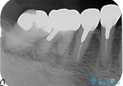 大臼歯 再根管治療の治療前