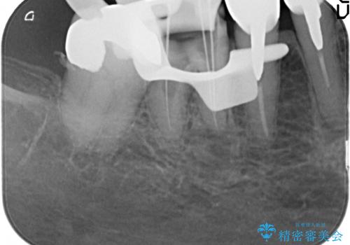 大臼歯　再根管治療の治療中